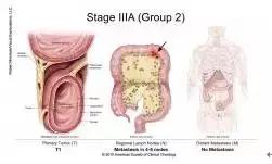 得了直肠癌怎么知道,你了解结直肠癌吗