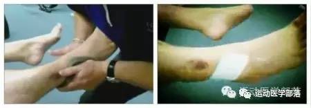 崴脚反复肿是什么原因,反复的脚崴怎么治疗