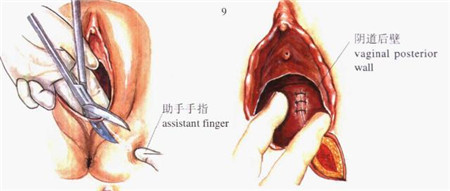 侧切有多疼产妇自述,产妇顺产侧切为啥越来越痛