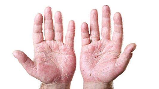 手脚脱皮是什么原因造成的，如何处理才好？