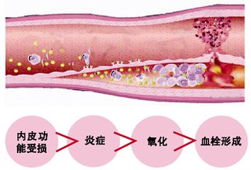 左侧股总动脉粥样斑块形成,吸烟造成动脉粥样斑块形成