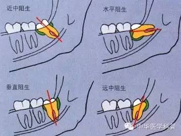 长智齿朋友圈说说心情,智齿的说说