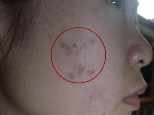 如何让脸变得没有痘变得更白净,脸上全是大大小小的红痘印