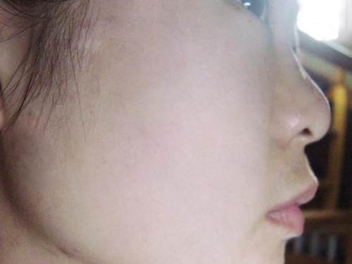 如何让脸变得没有痘变得更白净,脸上全是大大小小的红痘印