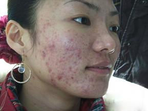 战痘的小秘诀,战痘的血泪史完全版