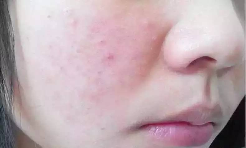 祛痘印的小窍门书籍,真正有用的祛痘印方法