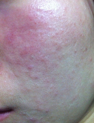 超声刀效果怎么样,超声刀效果最好时间