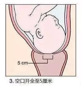 生娃打开宫口的流程,孕妇宫口开1指到生需要多久