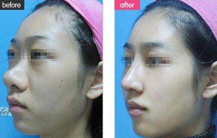 鼻翼缩小鼻子更大,让鼻翼缩小的方法