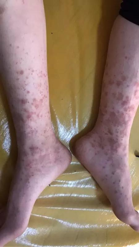 过敏性紫癜的危害有哪些,过敏性紫癜喝冷饮的危害