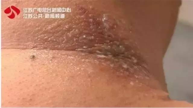 蚊子皮肤细菌感染溃烂,蚊虫叮咬能够拍吗