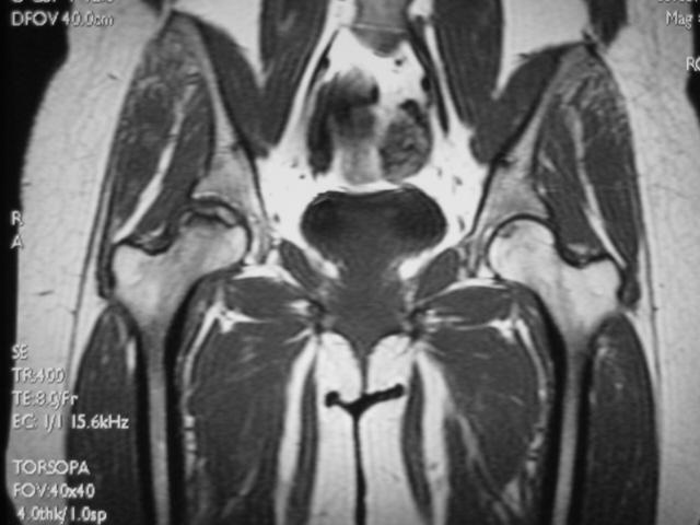 早期股骨头坏死核磁共振能看到吗,股骨头坏死修复过程的磁共振表现