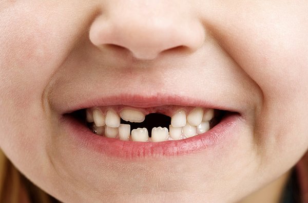 牙齿掉了一颗镶牙要多少钱,最后一颗牙齿掉了怎么镶牙