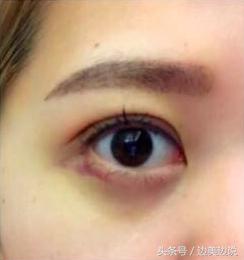 外科医生申霄,申霄医生双眼皮风格