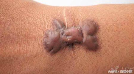 细疤痕怎么去掉最好方法,去除多年疤痕教你一个小妙招