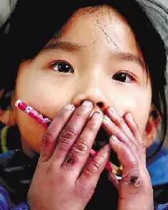 转暖时节，冻疮易复发，你造吗？