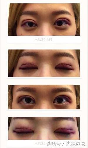 外科医生申霄,申霄医生双眼皮风格