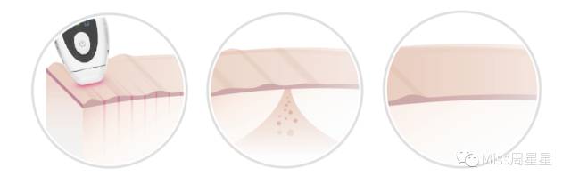 提拉紧致抗衰老美肤仪,提拉紧致美容仪效果最好的