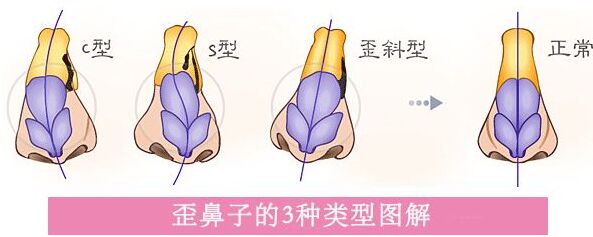 歪鼻子去哪里矫正,歪鼻子应该怎么办呢