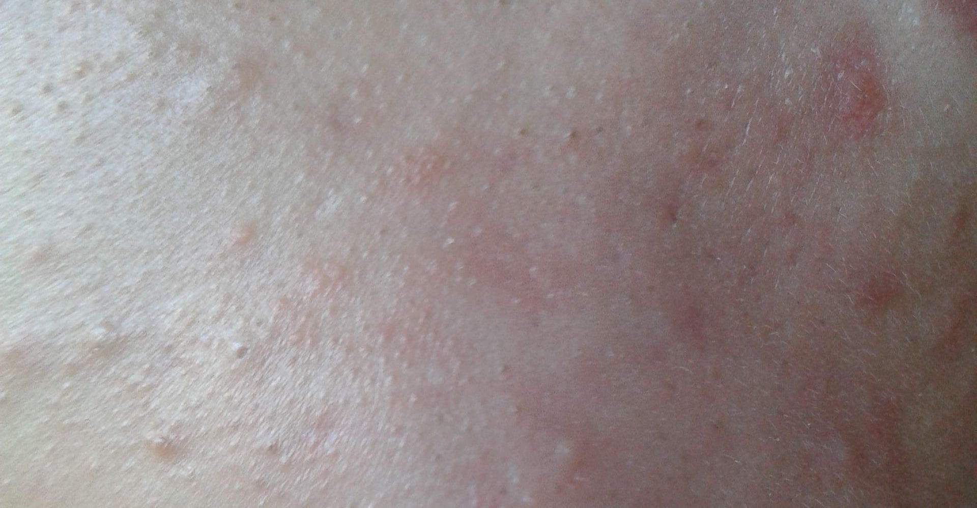 下巴有肉刺是什么病,下巴下面长很多小白点像白粉刺