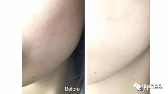 提拉紧致抗衰老美肤仪,提拉紧致美容仪效果最好的