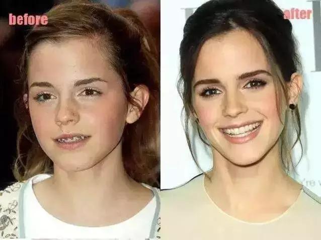 孩子牙齿畸形怎么办,小孩子牙畸形怎么办