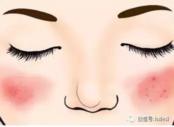 脸上红血丝敏感肌应该怎么修复,怎样修复敏感泛红血丝肌肤