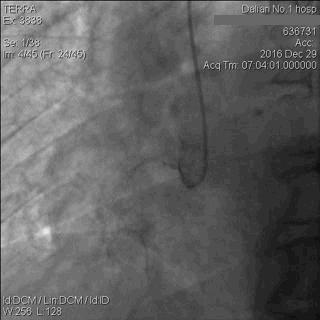 急性心肌梗死心源性休克时的处理,急性心肌梗死心源性休克最常见