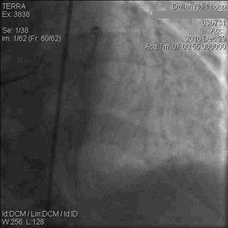 急性心肌梗死心源性休克时的处理,急性心肌梗死心源性休克最常见