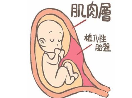 31岁孕妇在医院剖腹产,胎儿34周剖宫产取出能够存活吗
