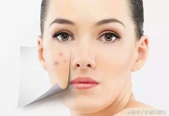 激光祛痘印危害与效果,激光祛痘印真的有效吗