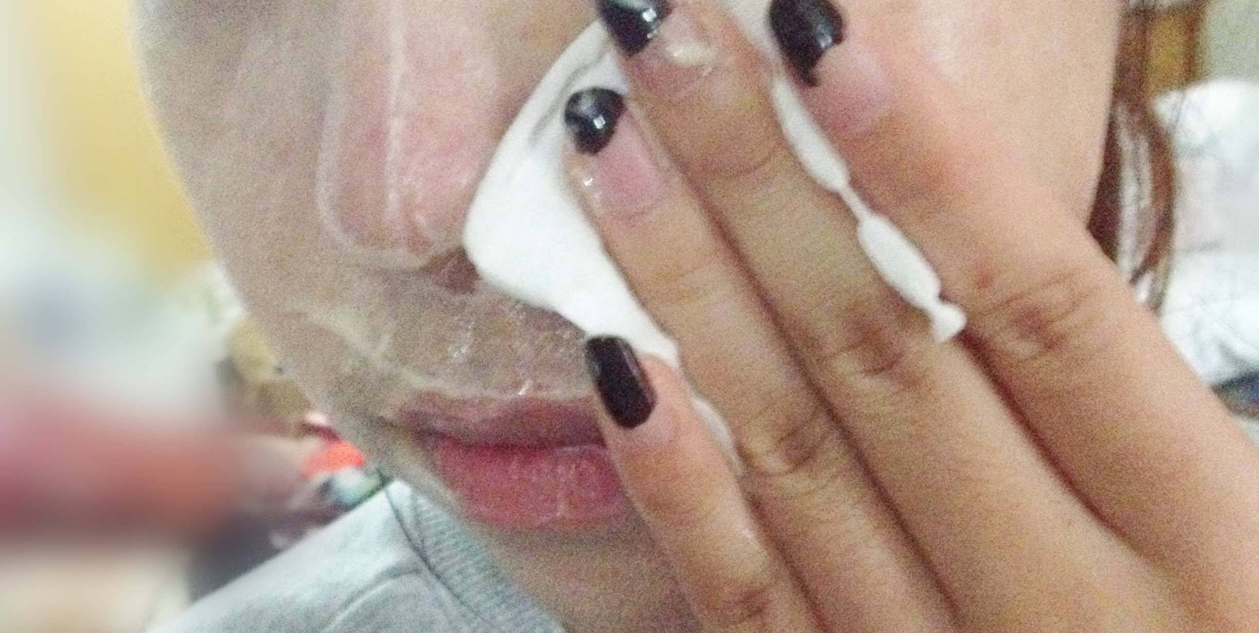 下巴有肉刺是什么病,下巴下面长很多小白点像白粉刺