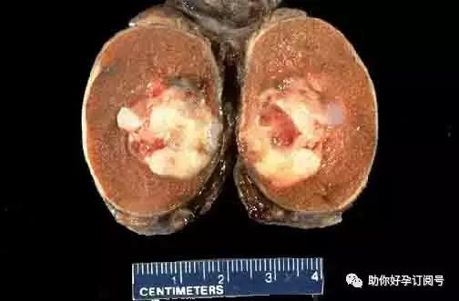 畸胎瘤的症状及治疗方法,五厘米的畸胎瘤有什么症状