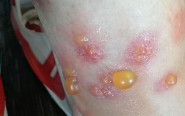 腿上被蚊子咬了留下的疤痕怎么祛,腿上被蚊子咬后留下的黑疙瘩图片