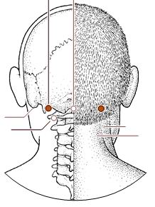 脊髓型颈椎病针灸治疗处方,神经根型颈椎病针灸绝技