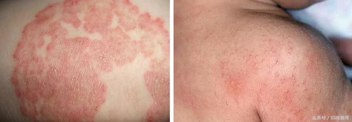 宝宝湿疹和痱子的区别怎么看,痱子和湿疹该怎么辨别