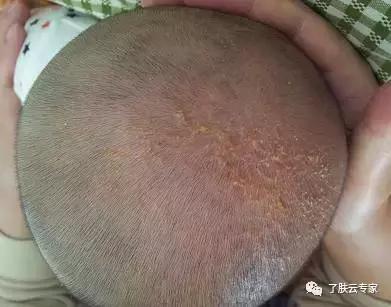 儿童皮肤病防治知识大全,儿童皮肤科护理流程