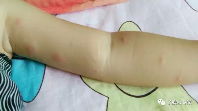 儿童皮肤病防治知识大全,儿童皮肤科护理流程