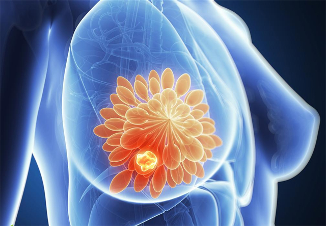 asco抗癌治疗,her2乳腺癌脑转移新药