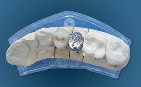 牙医怎么选最好,如何选择合适的烤瓷牙