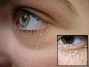 脂肪粒用什么方法能让它消除,眼部脂肪粒消除最快方法