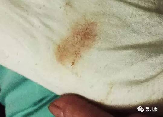 行家在线丨宝宝吐奶为何是红褐色的？婴幼儿反复发烧该怎么办？流鼻涕能够接种疫苗吗？