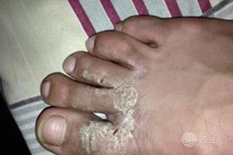 怎样预防脚痛症,怎样预防脚部疾病