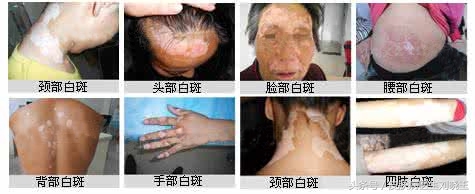 白癜风早期能够吃白癜风胶囊吗,白癜风怎么才能知道已经治好了