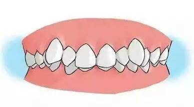 2岁儿童牙齿反颌矫正方法图片,12岁前必须矫正牙颌畸形吗