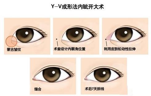 眼睛整形开眼角,眼睛变大的方法手术