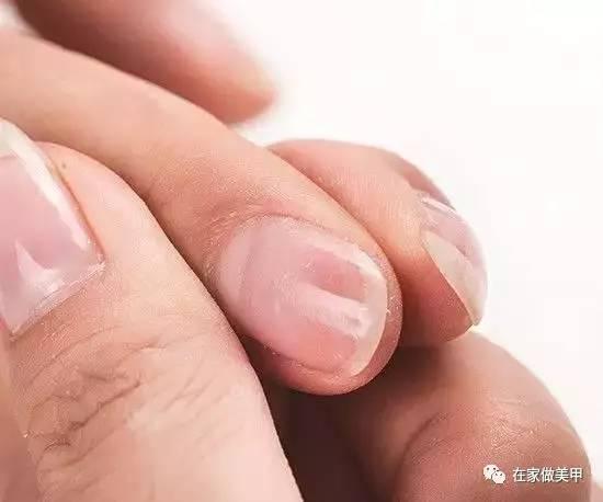 玛蒂被折断手指,玛蒂折断手指