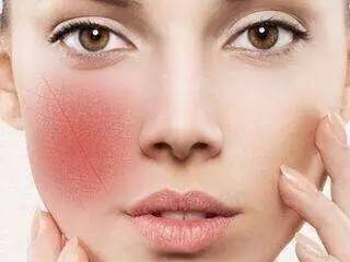 激素依赖性皮炎夏季更严重,激素依赖性皮炎好了该怎么护理