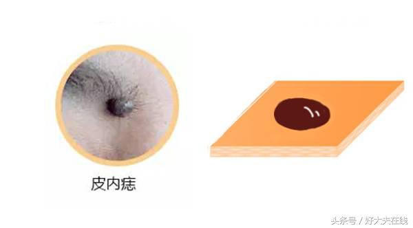 痣短期变大一定是恶化吗,医生能否判断痣是否正常