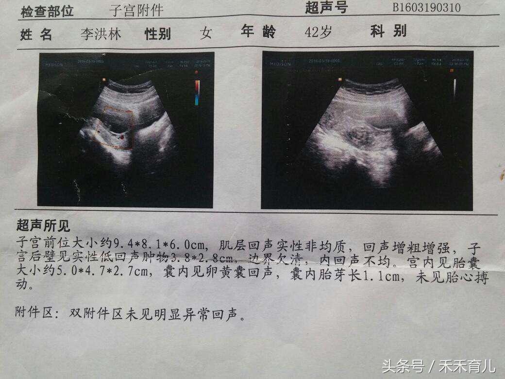 胎停育后再次怀孕注意哪些事项,有过一次胎停育再次怀孕注意什么